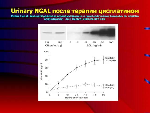 Urinary NGAL после терапии цисплатином Mishra J et al. Neutrophil gelatinase-associated lipocalin: