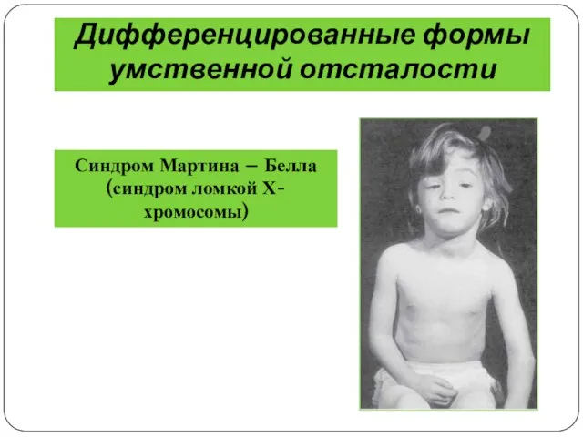 Дифференцированные формы умственной отсталости Синдром Мартина – Белла(синдром ломкой Х- хромосомы)