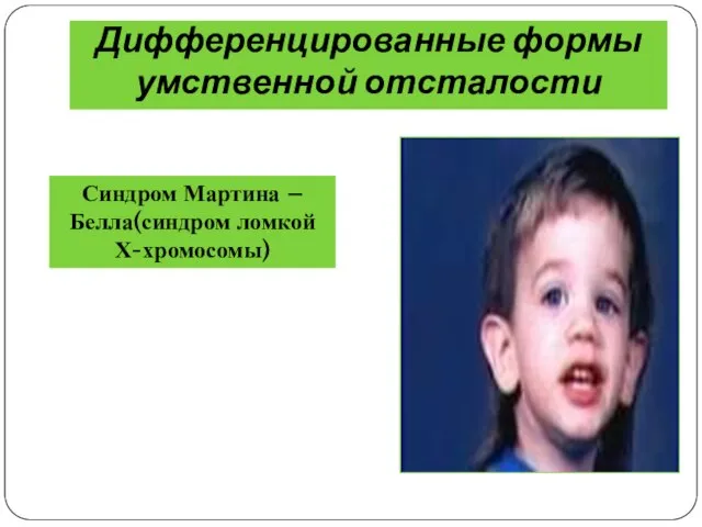 Дифференцированные формы умственной отсталости Синдром Мартина –Белла(синдром ломкой Х-хромосомы)