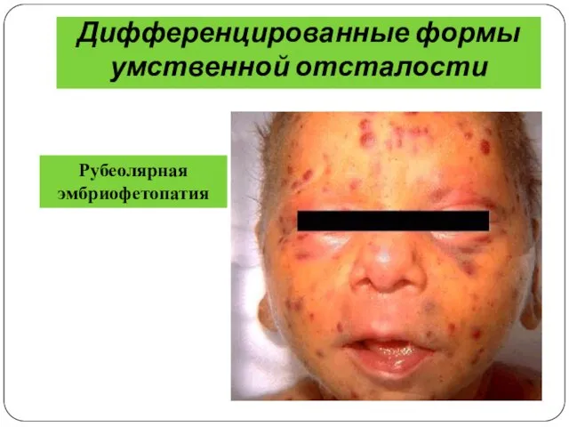 Дифференцированные формы умственной отсталости Рубеолярная эмбриофетопатия