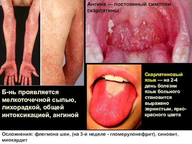 Скарлатиновый язык — на 2-4 день болезни язык больного становится выражено зернистым,