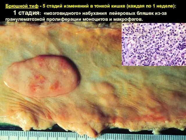 Брюшной тиф - 5 стадий изменений в тонкой кишке (каждая по 1