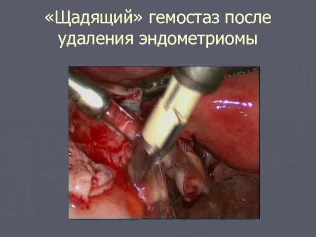 «Щадящий» гемостаз после удаления эндометриомы