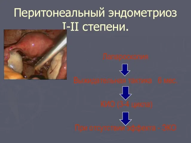 Перитонеальный эндометриоз I-II степени. Лапароскопия Выжидательная тактика 6 мес. КИО (3-4 цикла)