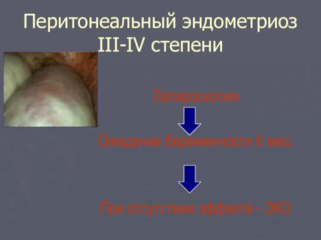 Перитонеальный эндометриоз III-IV степени Лапароскопия Ожидание беременности 6 мес. При отсутствии эффекта - ЭКО