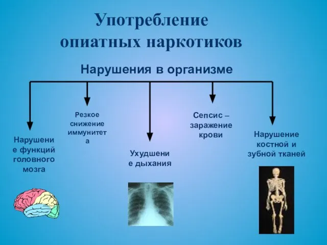 Употребление опиатных наркотиков Нарушение функций головного мозга Нарушение костной и зубной тканей