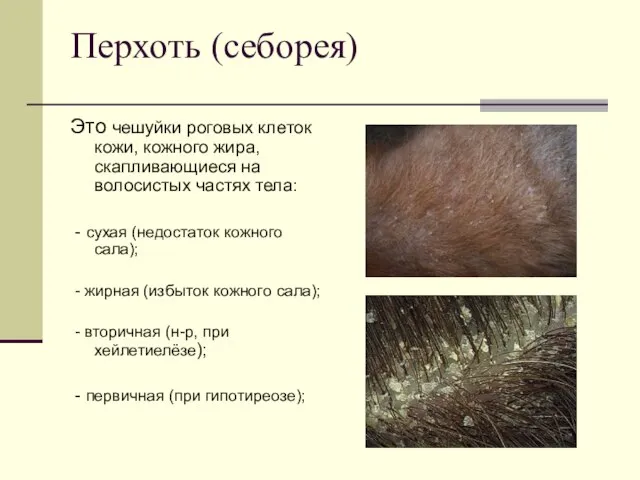 Перхоть (себорея) Это чешуйки роговых клеток кожи, кожного жира, скапливающиеся на волосистых