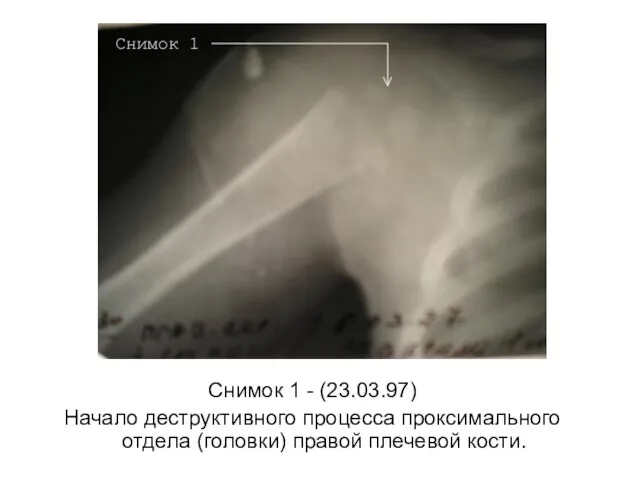 Снимок 1 - (23.03.97) Начало деструктивного процесса проксимального отдела (головки) правой плечевой кости.