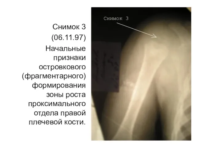 Снимок 3 (06.11.97) Начальные признаки островкового (фрагментарного) формирования зоны роста проксимального отдела правой плечевой кости.