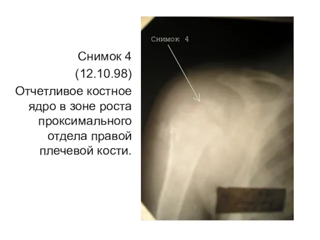 Снимок 4 (12.10.98) Отчетливое костное ядро в зоне роста проксимального отдела правой плечевой кости.