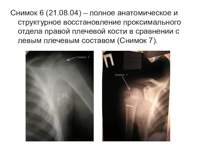 Снимок 6 (21.08.04) – полное анатомическое и структурное восстановление проксимального отдела правой