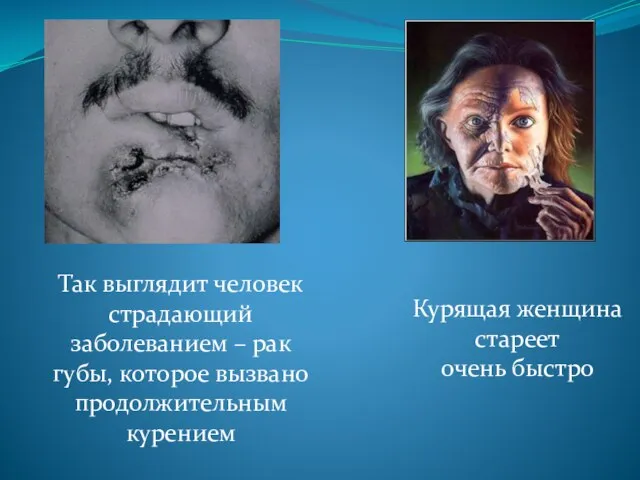 Так выглядит человек страдающий заболеванием – рак губы, которое вызвано продолжительным курением