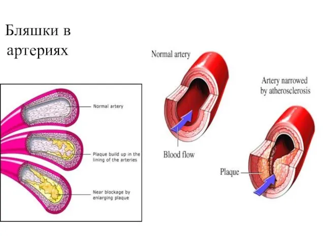 Бляшки в артериях