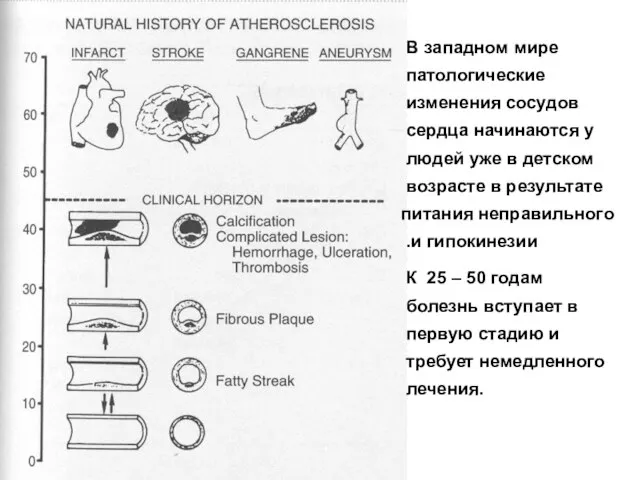 В западном мире патологические изменения сосудов сердца начинаются у людей уже в