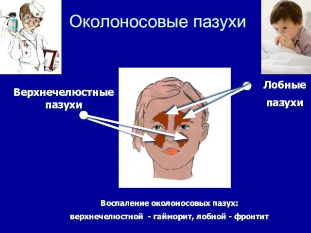 Околоносовые пазухи Лобные пазухи Верхнечелюстные пазухи Воспаление околоносовых пазух: верхнечелюстной - гайморит, лобной - фронтит