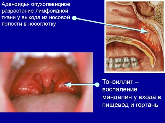 Аденоиды- опухолевидное разрастание лимфоидной ткани у выхода из носовой полости в носоглотку