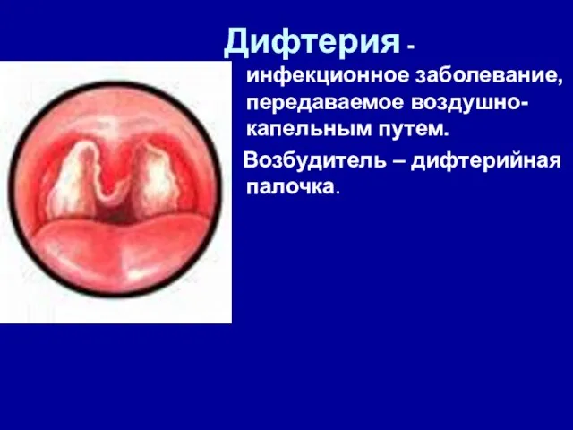 Дифтерия - инфекционное заболевание, передаваемое воздушно-капельным путем. Возбудитель – дифтерийная палочка.