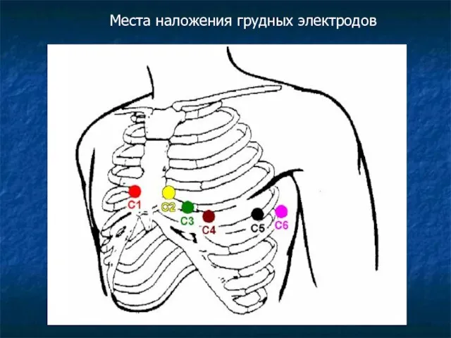 Места наложения грудных электродов