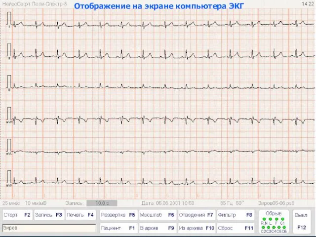 Отображение на экране компьютера ЭКГ