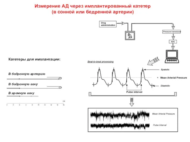 Измерение АД через имплантированный катетер (в сонной или бедренной артерии) Катетеры для