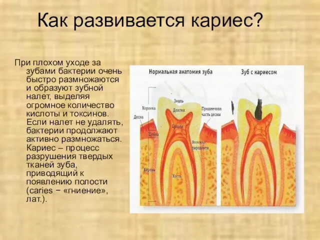 Как развивается кариес? При плохом уходе за зубами бактерии очень быстро размножаются