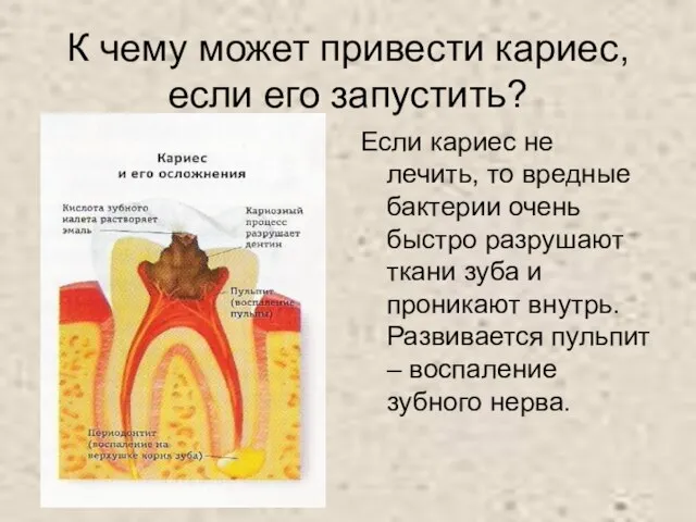 К чему может привести кариес, если его запустить? Если кариес не лечить,