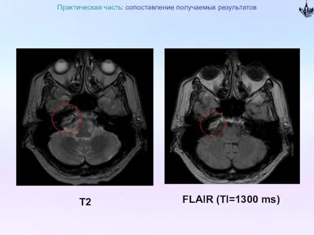 Практическая часть: сопоставление получаемых результатов Т2 FLAIR (TI=1300 ms)