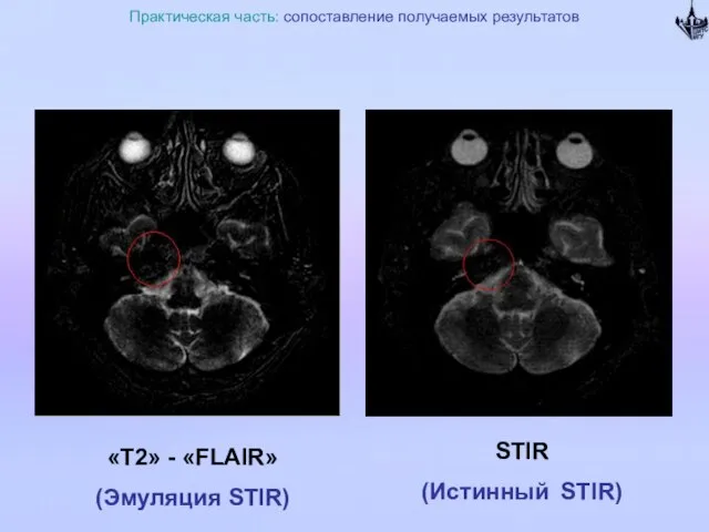 Практическая часть: сопоставление получаемых результатов «Т2» - «FLAIR» (Эмуляция STIR) STIR (Истинный STIR)