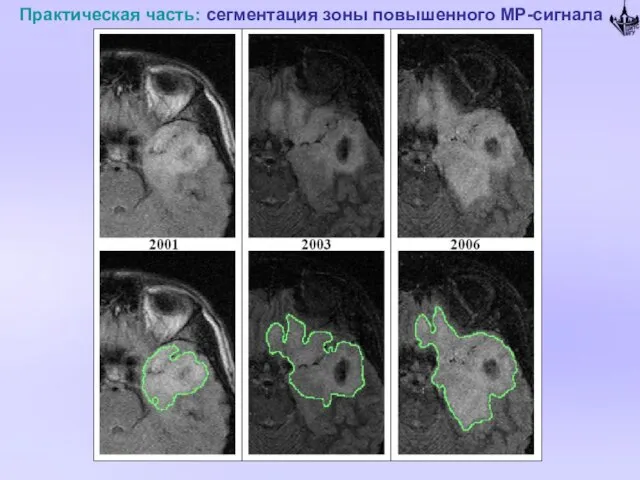 Практическая часть: сегментация зоны повышенного МР-сигнала