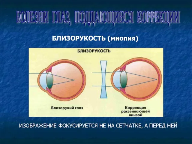 БОЛЕЗНИ ГЛАЗ, ПОДДАЮЩИЕСЯ КОРРЕКЦИИ БЛИЗОРУКОСТЬ (миопия) ИЗОБРАЖЕНИЕ ФОКУСИРУЕТСЯ НЕ НА СЕТЧАТКЕ, А ПЕРЕД НЕЙ