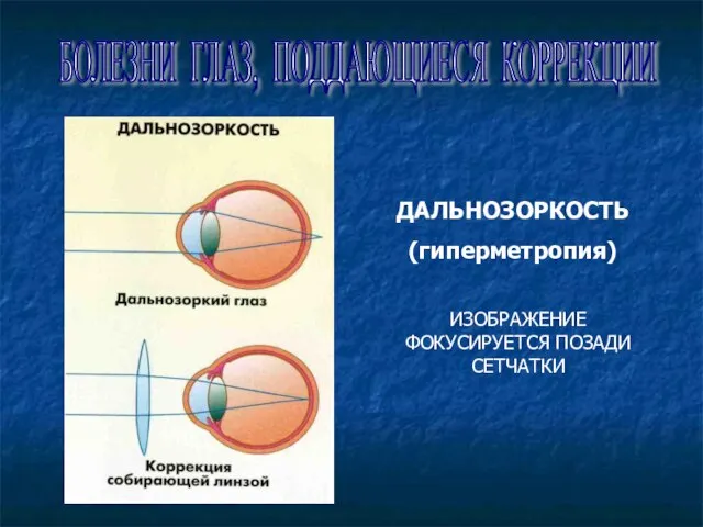 БОЛЕЗНИ ГЛАЗ, ПОДДАЮЩИЕСЯ КОРРЕКЦИИ ДАЛЬНОЗОРКОСТЬ (гиперметропия) ИЗОБРАЖЕНИЕ ФОКУСИРУЕТСЯ ПОЗАДИ СЕТЧАТКИ