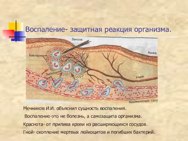 Воспаление- защитная реакция организма. Мечников И.И. объяснил сущность воспаления. Воспаление-это не болезнь,