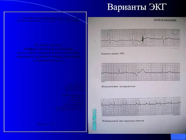 Варианты ЭКГ