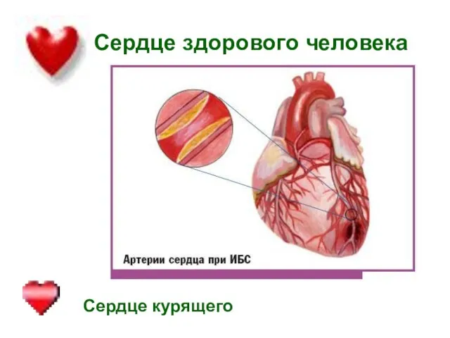 Сердце здорового человека Сердце курящего