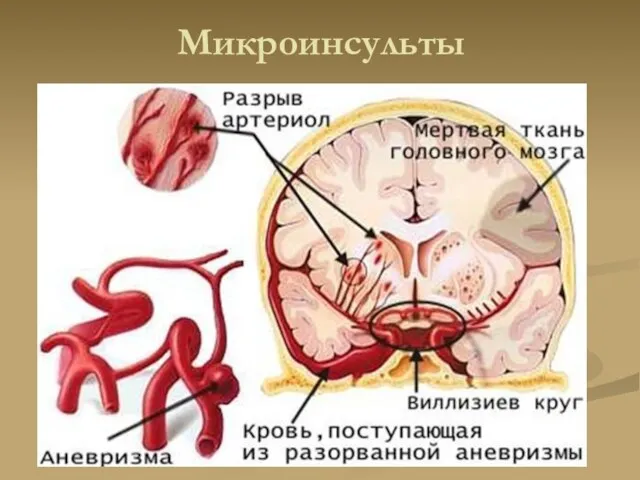 Микроинсульты