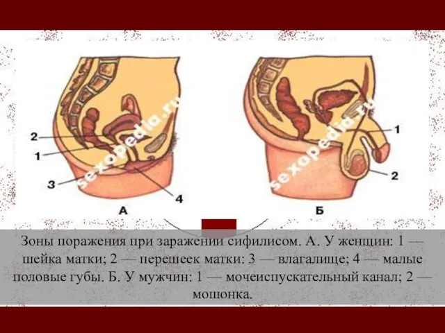 Зоны поражения при заражении сифилисом. А. У женщин: 1 — шейка матки;