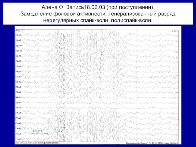 Алена Ф. Запись18.02.03 (при поступлении). Замедление фоновой активности. Генерализованный разряд нерегулярных спайк-волн, полиспайк-волн.