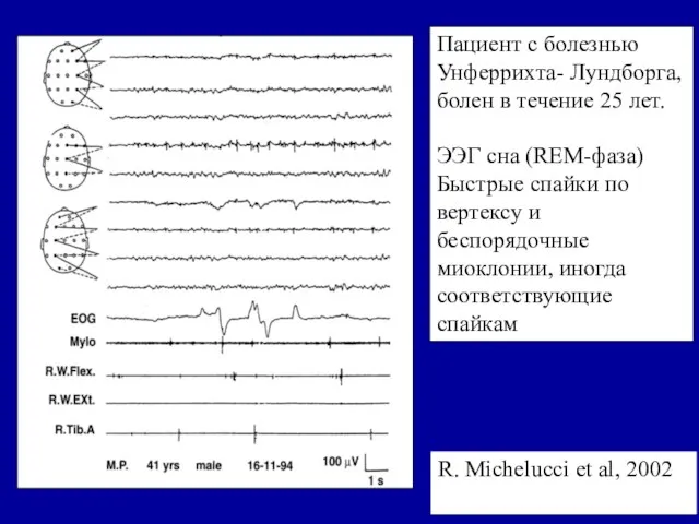 Пациент с болезнью Унферрихта- Лундборга, болен в течение 25 лет. ЭЭГ сна