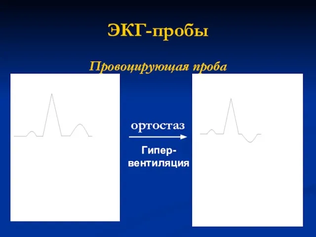 ЭКГ-пробы Провоцирующая проба ортостаз Гипер- вентиляция