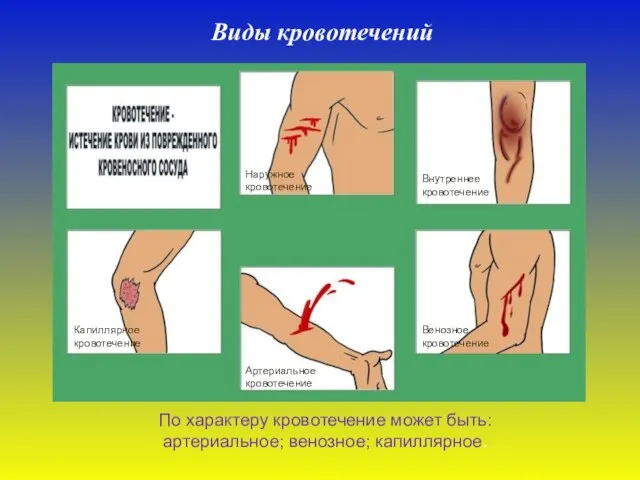 Виды кровотечений Артериальное кровотечение Венозное кровотечение Внутреннее кровотечение Капиллярное кровотечение Наружное кровотечение