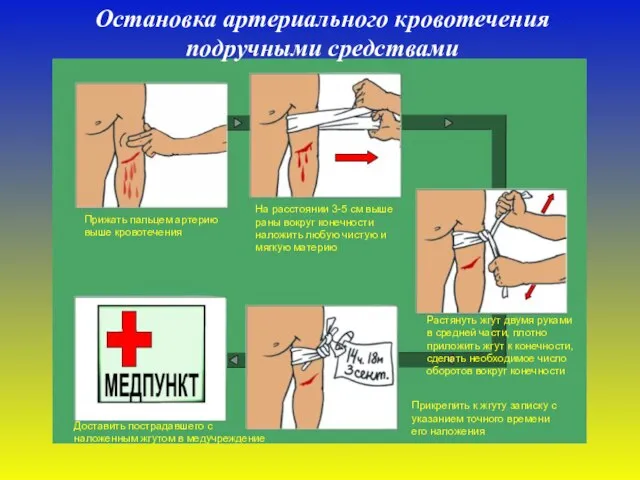 Остановка артериального кровотечения подручными средствами Прижать пальцем артерию выше кровотечения На расстоянии