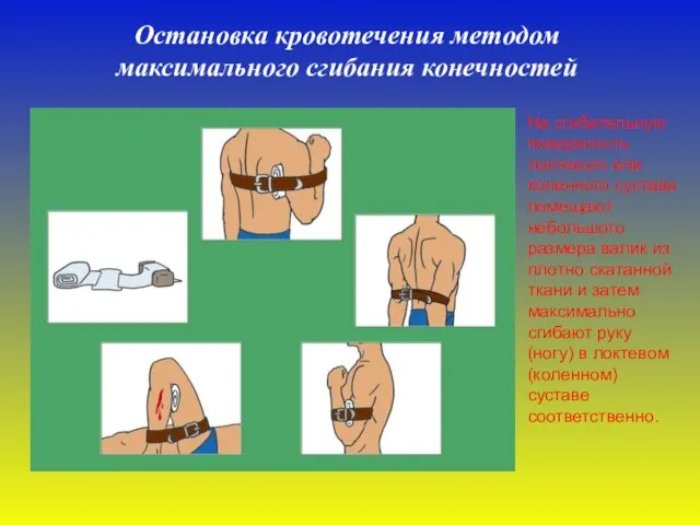 Остановка кровотечения методом максимального сгибания конечностей На сгибательную поверхность локтевого или коленного