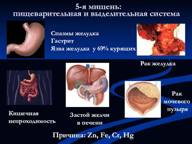 5-я мишень: Кишечная непроходимость Спазмы желудка Гастрит Язва желудка у 69% курящих