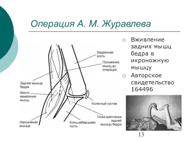 Операция А. М. Журавлева Вживление задних мышц бедра в икроножную мышцу Авторское свидетельство 164496