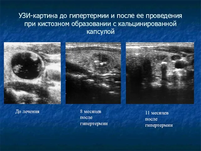 УЗИ-картина до гипертермии и после ее проведения при кистозном образовании с кальцинированной