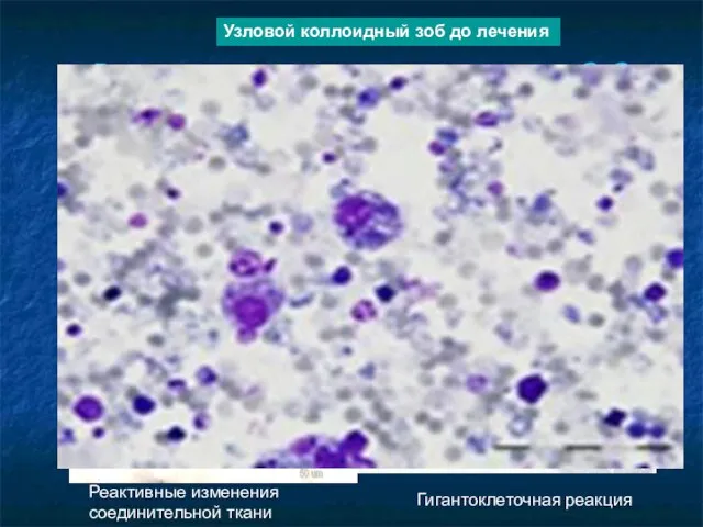 Реактивные изменения через 2-3 недели после процедуры Реактивные изменения соединительной ткани Гигантоклеточная