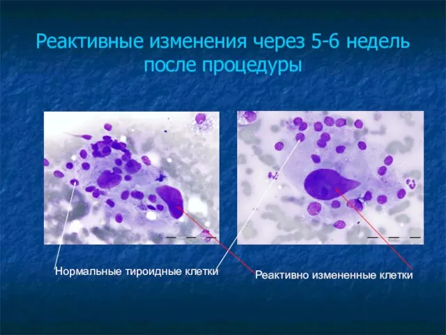 Реактивные изменения через 5-6 недель после процедуры Нормальные тироидные клетки Реактивно измененные клетки