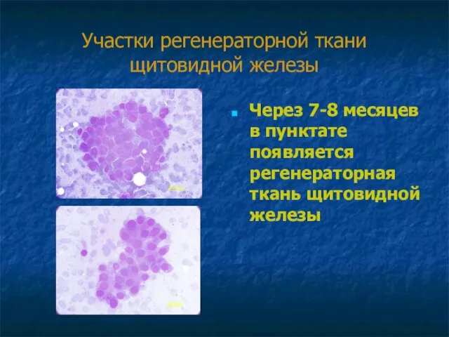 Участки регенераторной ткани щитовидной железы Через 7-8 месяцев в пунктате появляется регенераторная ткань щитовидной железы