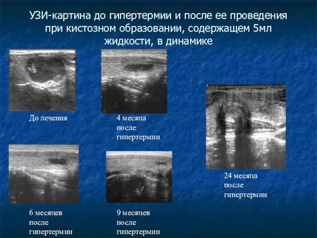 УЗИ-картина до гипертермии и после ее проведения при кистозном образовании, содержащем 5мл