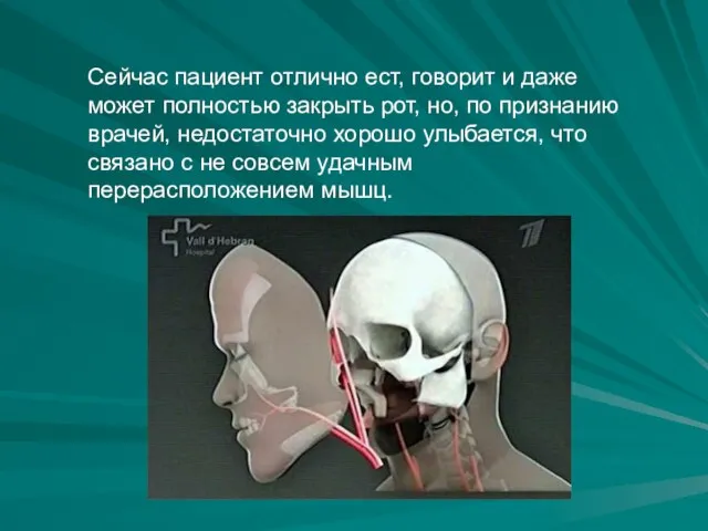 Сейчас пациент отлично ест, говорит и даже может полностью закрыть рот, но,